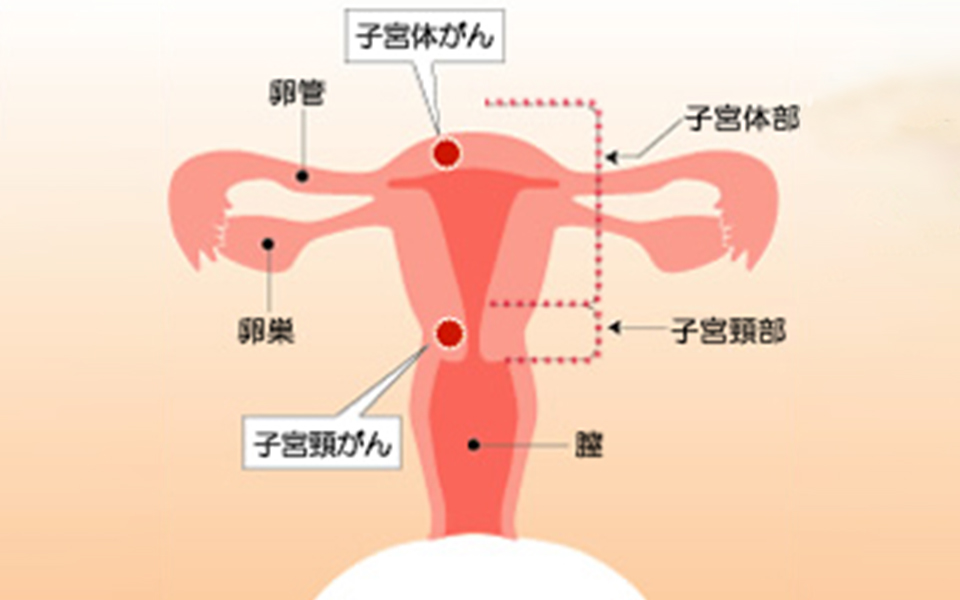 子宮がんの図